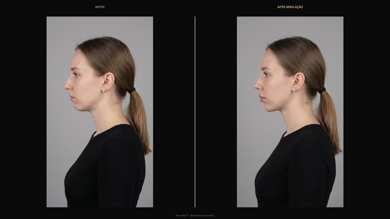 Giovana 26 — lip filler patient visualization