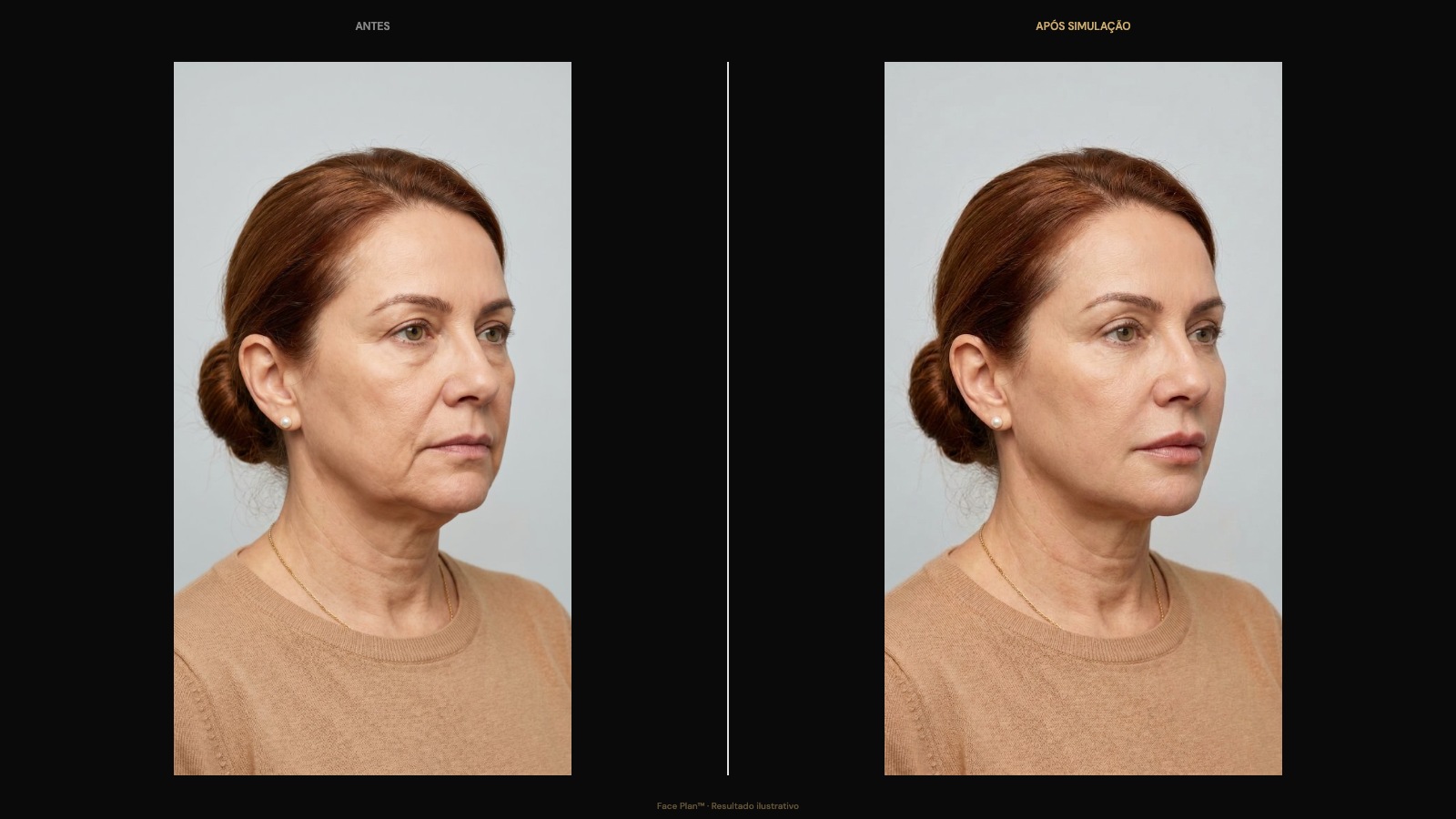 Before and after facial harmonization comparison generated by the Face Plan clinical simulator