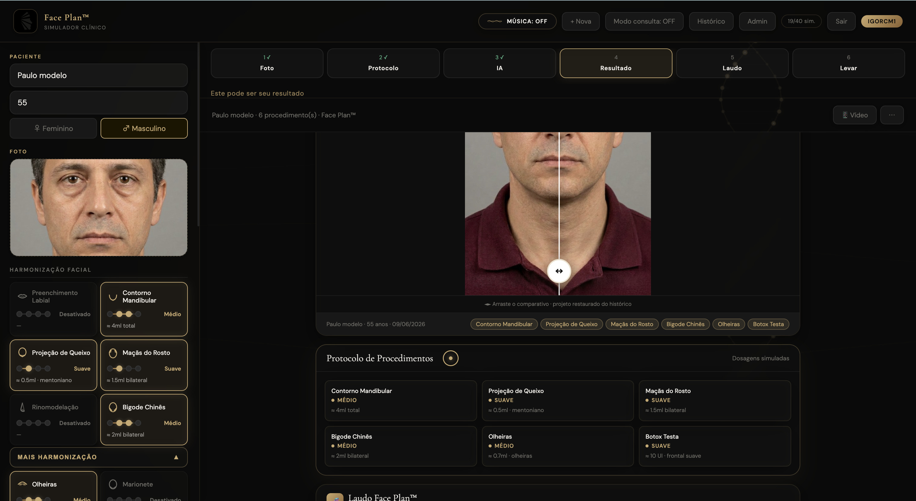 Paulo 55 — mature rejuvenation facial harmonization simulator