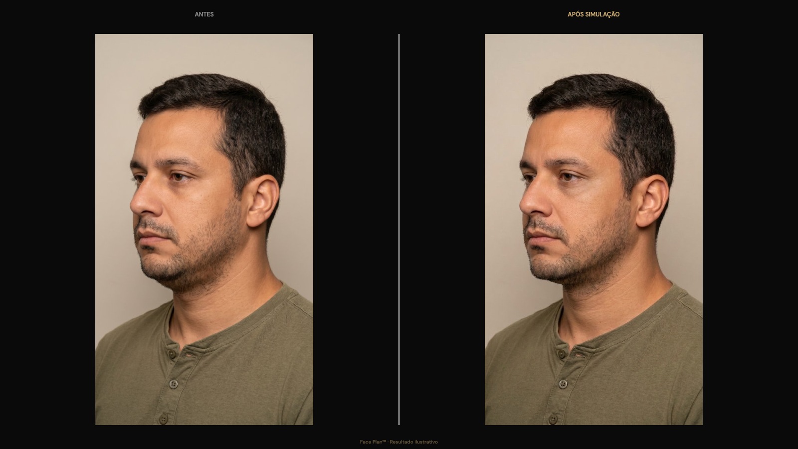 Tiago 38 — male facial harmonization before after